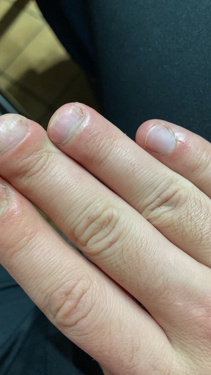 Xylocarde's tweet photo. @Maxouks C’est pas vraiment une cicatrice mais je l’aurai à vie 😂😭 (demi amputation de deux phalanges, après avoir les doigts qui sont passé dans une chaîne de moto en marche.) https://t.co/fVJPSurDSA
