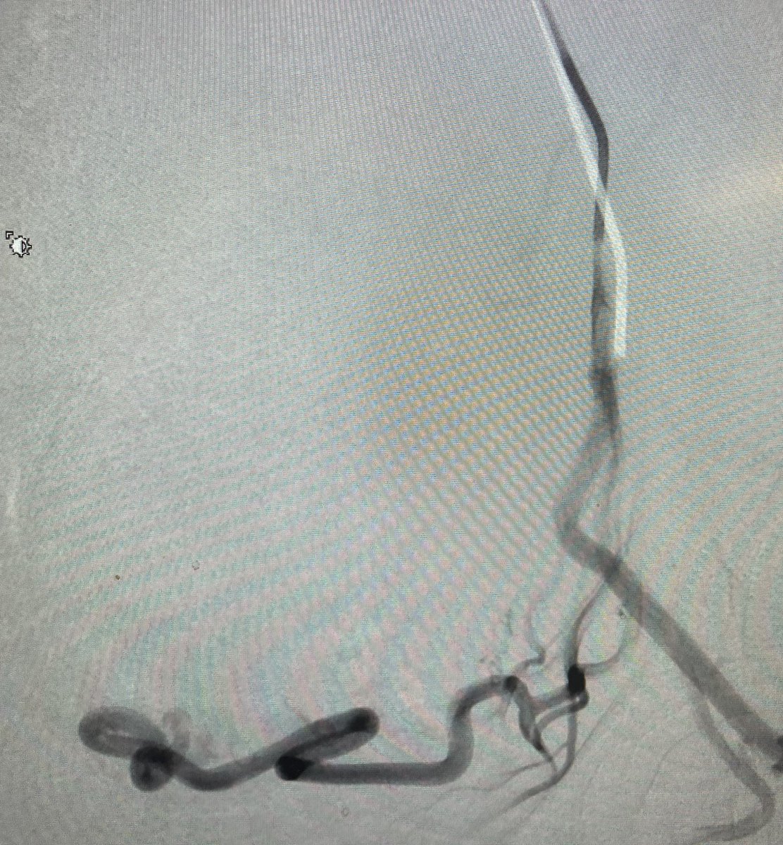 roblookstein's tweet photo. Live @MountSinaiIR What a week!! Eleven #UFE/#TRUFE procedures. So grateful to our pts who have trust and faith in our care and to our amazing staff @MountSinaiNYC @MountSinaiNurse @MountSinaiDMIR interventional technologists @FibroidsNoMore @fibroidforum @fibroidrelief https://t.co/6LF5HAM5wP