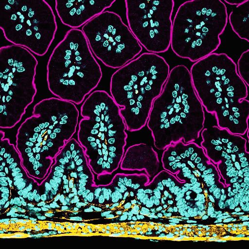 #FluorescenceFriday featuring alpha smooth muscle actin in yellow and Villin in magenta.  

#bioart #sciart #microscopy #histoart