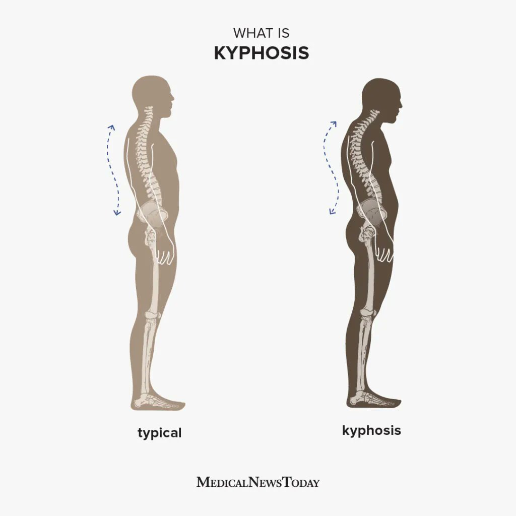AJACs Top 5 Exercises for POSTURE

Whether sitting too much or moving too little, people are becoming more bent over in how they stand &amp; move

This kyphotic posture is a common but easily solved problem

These exercises will get you stronger, breathing deeper, and standing taller