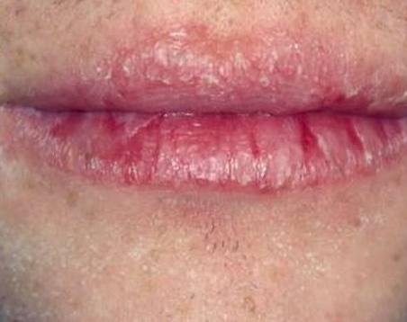 theiceraf's tweet photo. Korang ada masalah bibir pecah dan kering macam ni? 

I nak share 2 benda ni boleh buat bibir makin lembut dan sihat. https://t.co/BFtBtiIxgY