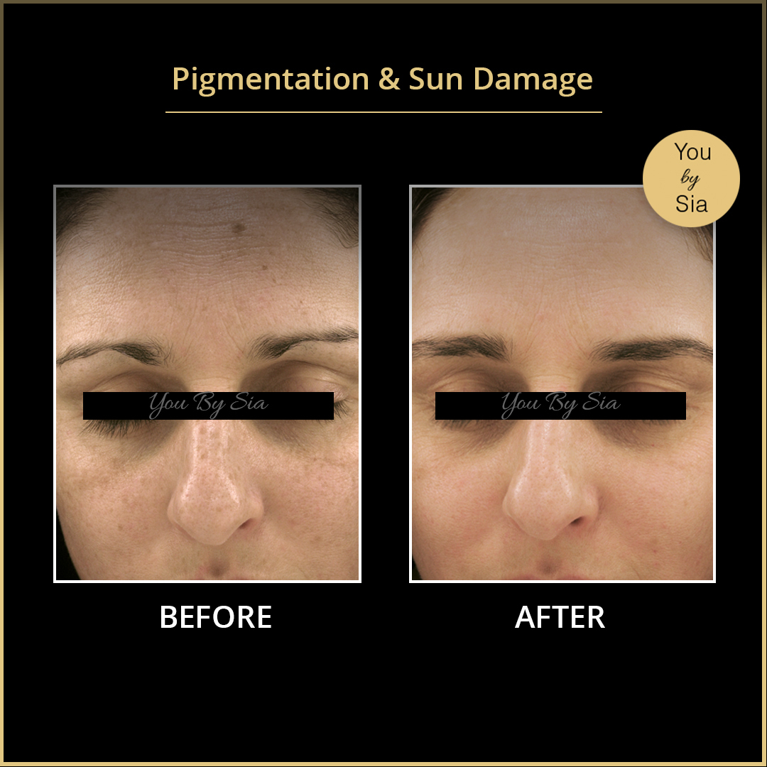 YouBySia's tweet image. Clients experienced an improvement in skin brightness, even complexion and a younger glowing healthy texture with our amazing treatments and skincare products. Beautiful results!

Call us at (02)83237510 to book your appointments

#laserpigmentation #clenz #release #shiftAM #Minc