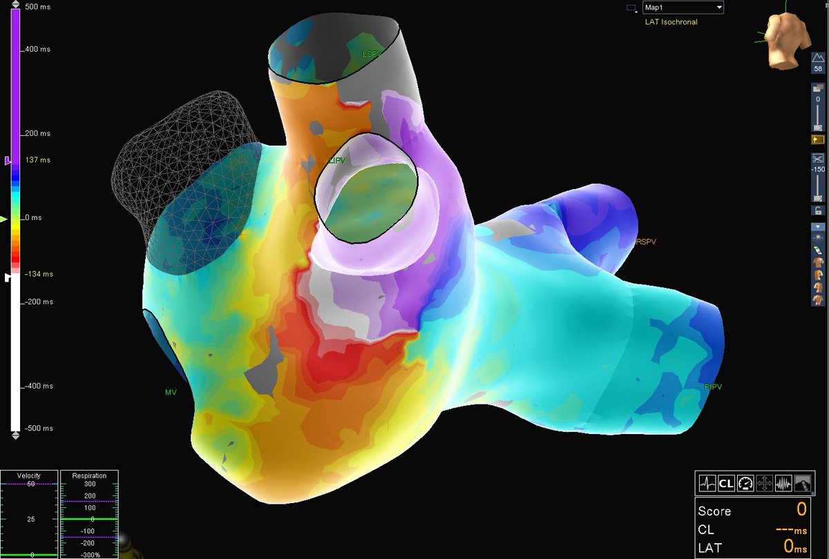 MartinovEm's tweet photo. Interesting case of #LAFL engaging left PVs. The tachycardia terminated during left antral #PVI. Great work with @TraykovVassil #HDGrid
@EPeeps https://t.co/2vqUERptFQ