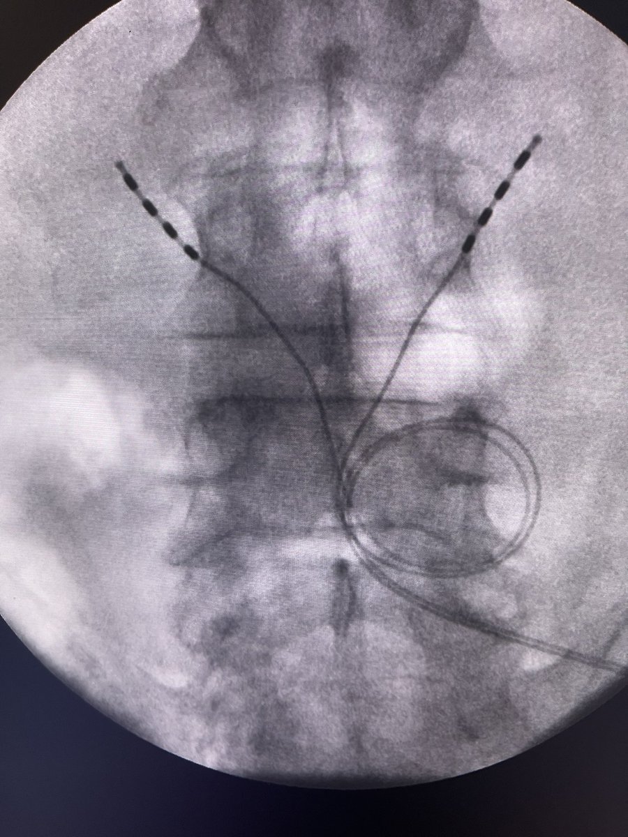 neuroradiology's tweet photo. Chronic low back pain from multifidus dysfunction has a new rehabilitation treatment now called Reactiv8. Fabulous thus far with patient’ satisfaction and evidence of 3 year data. @MainstayMedical @The_ASSR @TheASNR @SIRspecialists @ASPN_PainNeuro #cLBP #multifidusdysfunction https://t.co/Icq17EHMpK