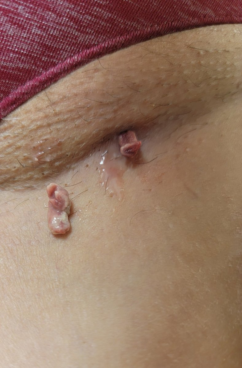 JamesKnellerMD's tweet photo. Surprises with the #Vascade venous closure device. Patient presented two weeks post #afib ablation with pain and induration at vascular access sites. Manual pressure applied and these tissue plugs popped out. #cardiva #haemonetics @Epeeps_Bot #EPeeps https://t.co/wR41WTAKiA