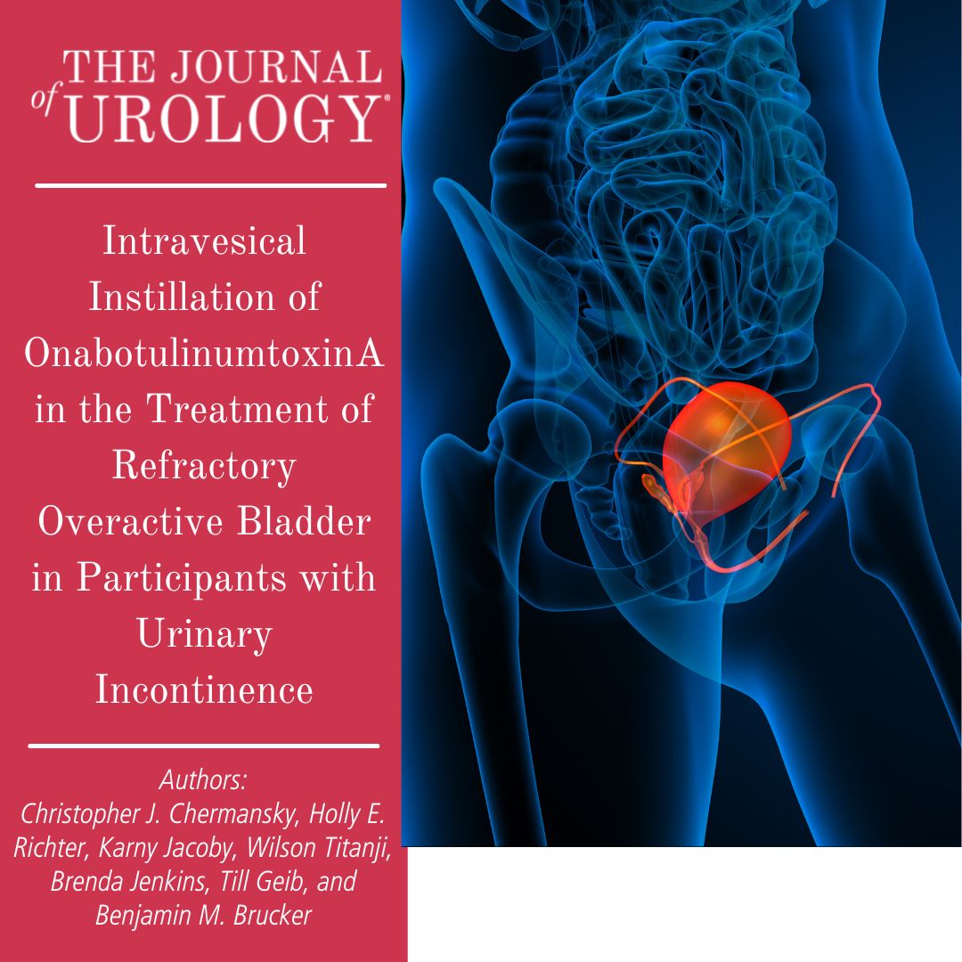 Delivery of onabotulinumtoxinA via instillation would reduce the need for intradetrusor injections. bit.ly/3CQzdzO By: Christopher J. Chermansky, Holly E. Richter, Karny Jacoby, Wilson Titanji, Brenda Jenkins, Till Geib, and Benjamin M. Brucker