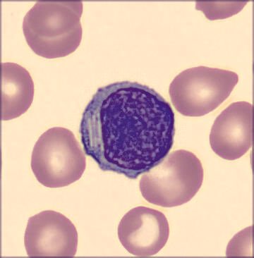 redb56's tweet image. #hemepath #pathology #hematology So, a patient with CLL came in today, and these showed up!