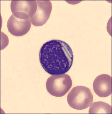 redb56's tweet image. #hemepath #pathology #hematology So, a patient with CLL came in today, and these showed up!