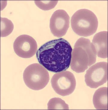 #hemepath #pathology #hematology So, a patient with CLL came in today, and these showed up!