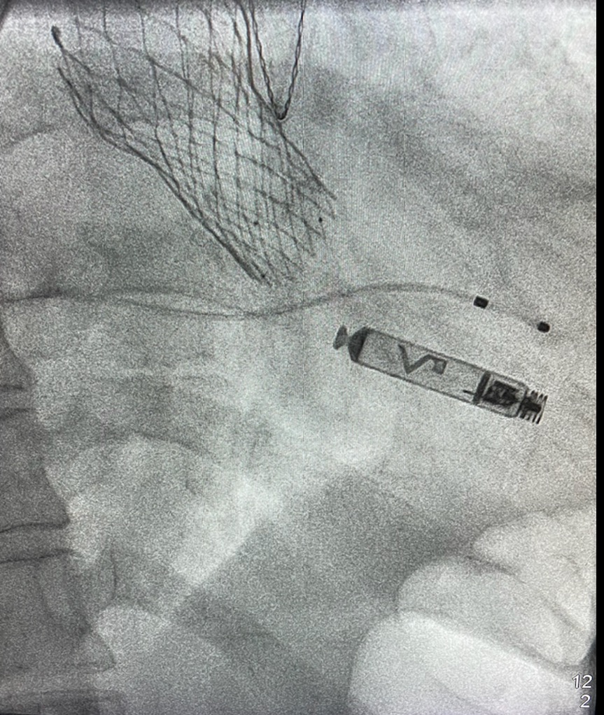 ZacharyHollisEP's tweet photo. We recently had a great case implanting Abbott's Aveir active fixation leadless pacemaker, the first for our patients and the state of Virginia.@atwater_brett @IHVInews https://t.co/jr5vCvfGZW