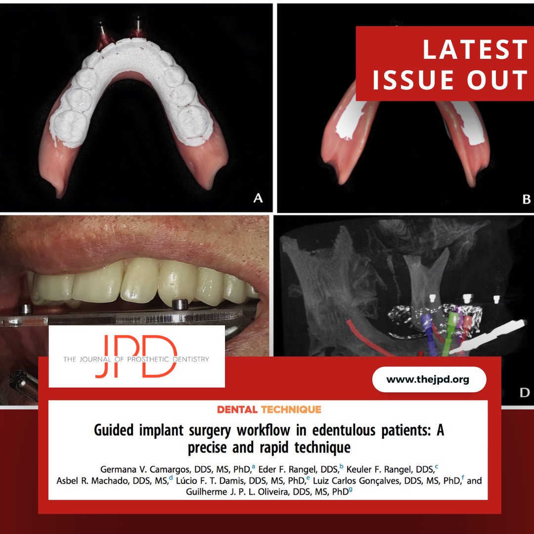 JPDentistry's tweet photo. The latest issue of #theJPD shares this #dentaltechnique on how to use a #completedenture into a radiographic guide, then surgical guide, and finally an interim #fixeddentalprosthesis. Learn more: https://t.co/vdbhBs2fN0 https://t.co/aLdmyfjpQo