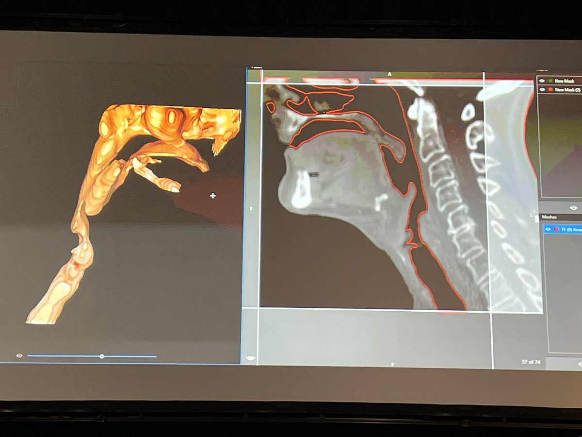 For head and neck pathology, existing patient scans can be used to visualize the airway and help plan anaesthetic management. @dr_imranahmad at #CSCwgtn2022 #anaesthesia #anesthesiology