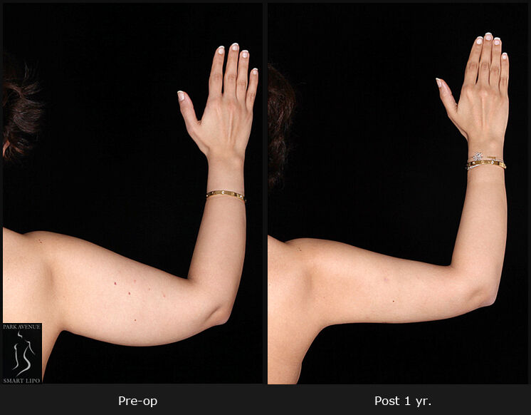 While #ArmLiposuction surgery removes stubborn arm fat, an arm lift is designed to address both unwanted fat and loose skin in the upper arms. An experienced #PlasticSurgeon will help you choose the right option for your needs. bit.ly/3MxNx3r