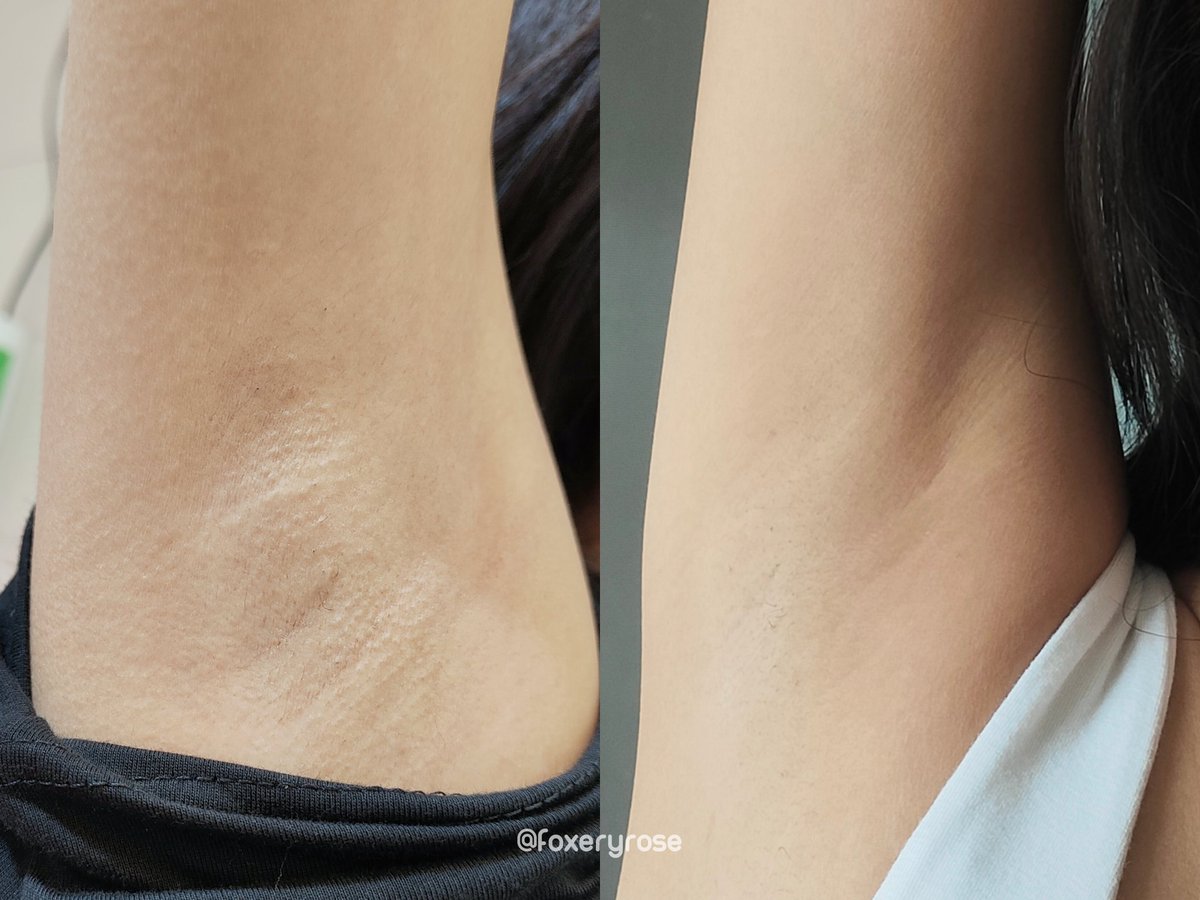 เปิดโปงความจริง! ใครว่าคนผอมไม่เจอปัญหารักแร้ดำ ไม่จริง!! สารพัด หาของมาใช้ จนมาเจอตัวนี้ อยากบอกต่อมาก ดีไม่จ้อจี้ ใช้มา 2 ทิตย์ หนังไก่หายแบบแทบมองไม่เห็น รอยคล้ำจางลงเยอะมาก ตอนนี้คือ เนียนจะเท่าท้องแขนเหละ แล้วคือ ทาแล้วเค้าช่วยเบลอผิวเบลอรูขุม ขนได้ด้วยนะ ปังๆ😍#ใช้ดีบอกต่อ