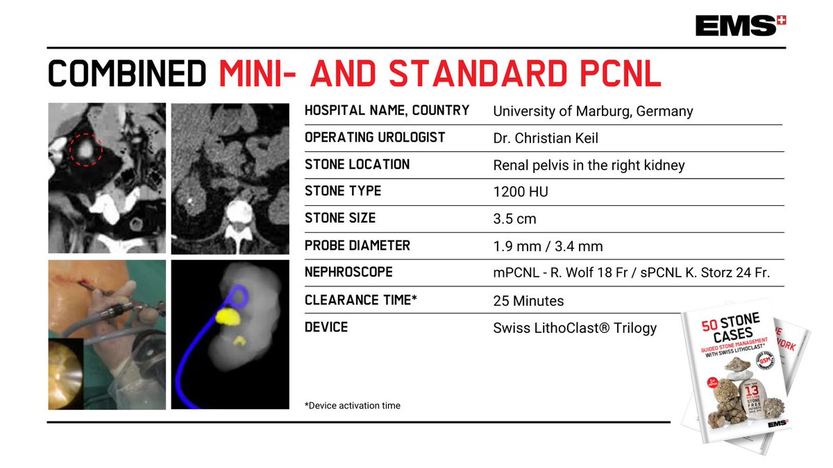 EMSUrology's tweet photo. Watch this great video of a combined mini and standard PCNL with our 1.9 mm probe to treat a very hard cystine stone. Watch the video here: https://t.co/iJ9wrAOnrL

Thank you, Dr. Christian Keil!

Contact us for more info on our new eBook! ✍ 

#IlovePCNL #LithoClast https://t.co/FbM1spnOYq