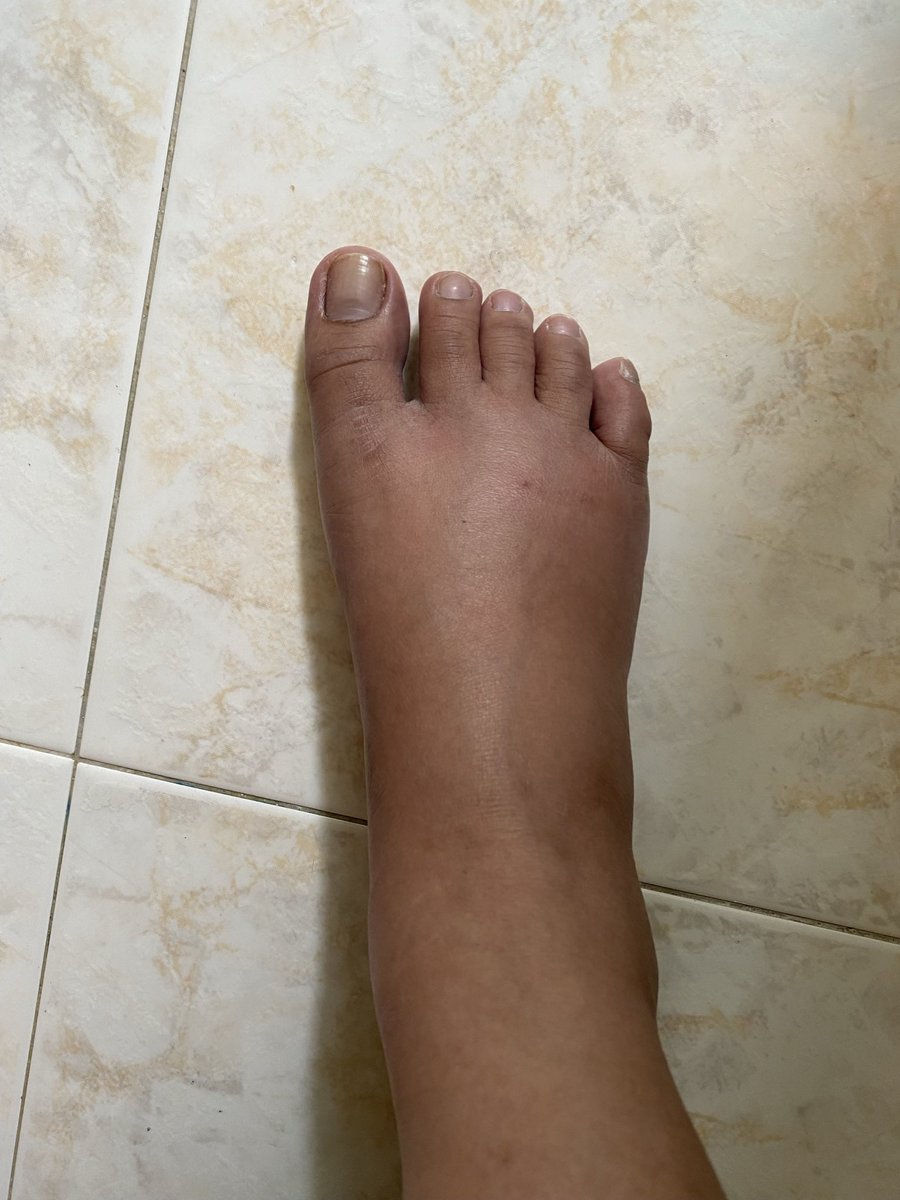 hp101191's tweet photo. This is how my feet look like now. Manas. Hehe https://t.co/zTCuTidRJc