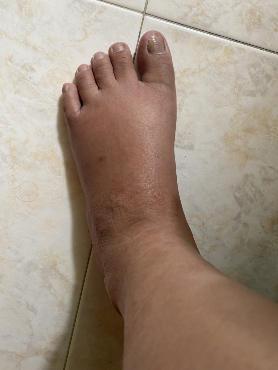 hp101191's tweet photo. This is how my feet look like now. Manas. Hehe https://t.co/zTCuTidRJc