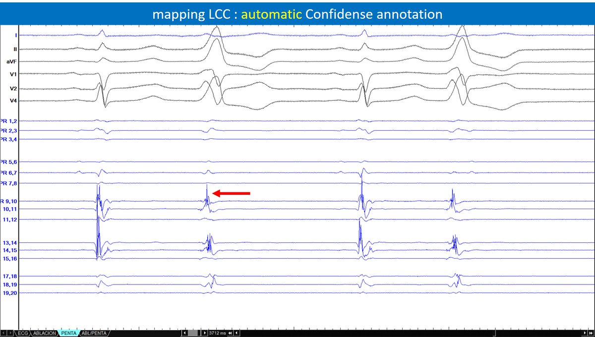 Arritmias H. Ramón y Cajal, Madrid. tweet media