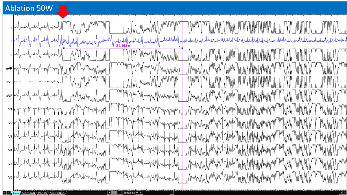 Arritmias H. Ramón y Cajal, Madrid. tweet media