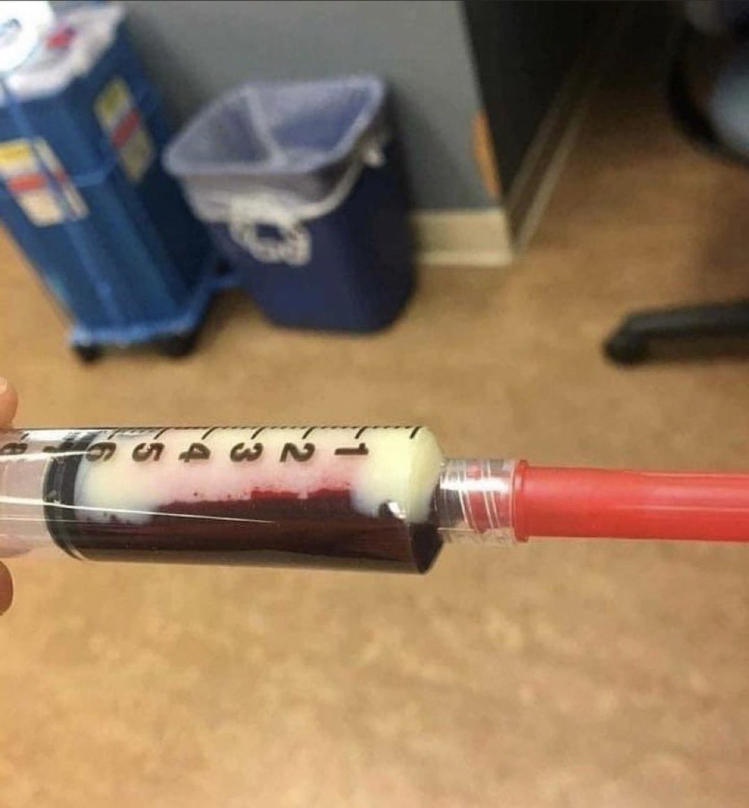 Severely high triglyceride levels turn your blood into grease!