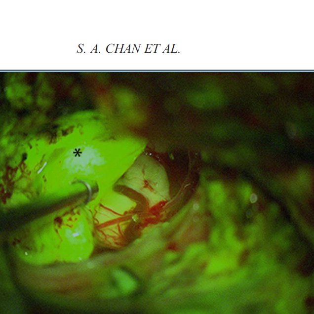 JamieVanGompel's tweet photo. Great paper on Intraoperative Flourescine use in #vestibularschwannoma resection by #stephanchan @MattCarlsonMD @JamieVanGompel @MichaelJLinkMD @PerisCelda #robertmacielak #collindriscoll #brianneff @OandNonline @MayoClinicNeuro @MayoClinicENT https://t.co/iGK3F9GWuF