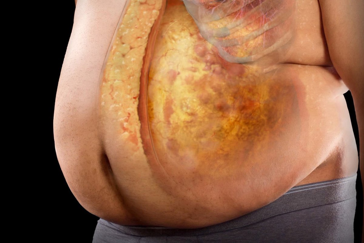 Your abdominal fat is destroying your organs and setting the stage for diabetes, heart disease, and cancer. Here's 5 ways you can shed that gut and take back control of your health: