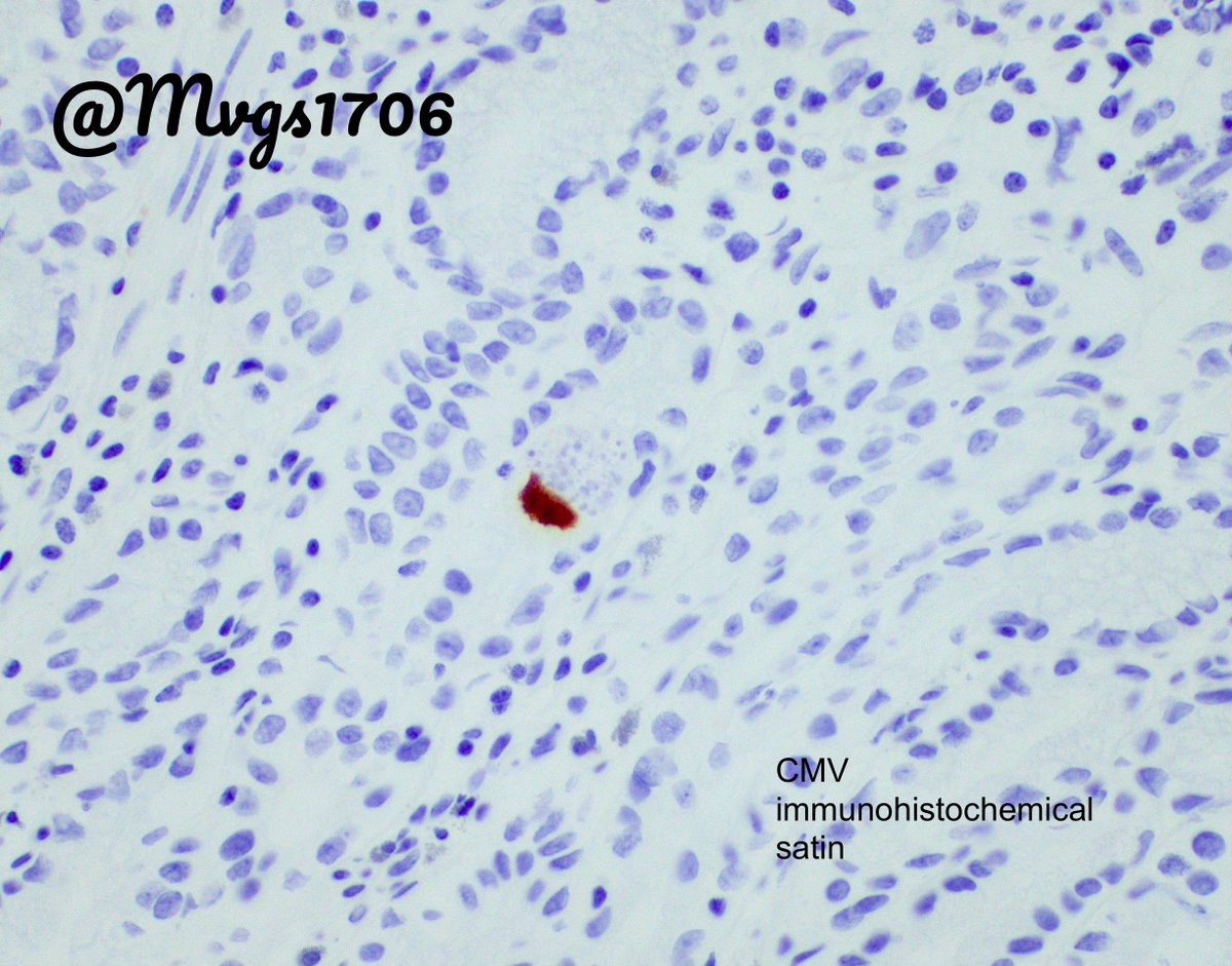 CMV can show a spectrum of histological changes - from ulcers, numerous apoptosis and even ischemia due to vasculitis.
This is perhaps most easy to miss - minimal inflammation
Even more tricky if h/o immunosuppression is not given, yikes!
Enjoy!
#GIpath