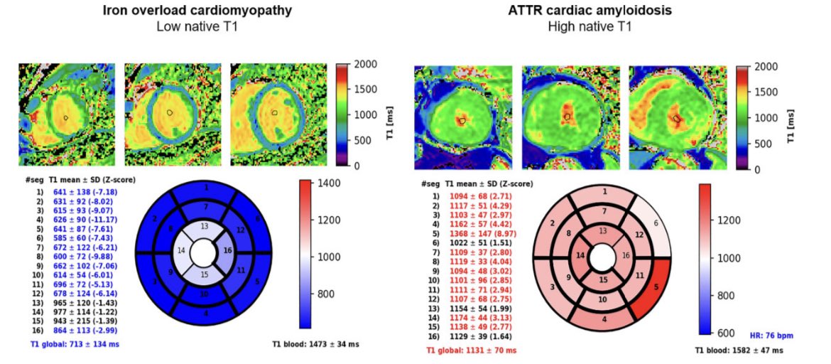 ⚠️Great review 👉 Restrictive cardiomyopathy 📍definition 📍diagnosis 📍therapies available only for cardiac amyloidosis and, for iron overload cardiomyopath 🆓📁 academic.oup.com/eurheartj/adva…