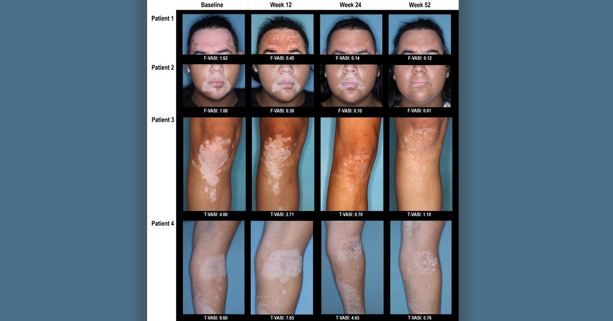 NEJM's tweet photo. In two phase 3, double-blind, placebo-controlled trials, the Janus kinase inhibitor ruxolitinib showed superiority to vehicle control in facial repigmentation of vitiligo. https://t.co/zgkUMYHtIO https://t.co/gP3cgVCrtK