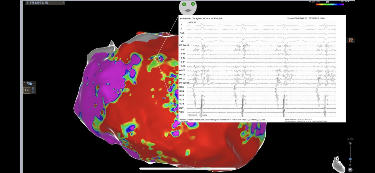 Tamer El Andere (@el_andere) on Twitter photo Late presentation of Brugada syndrome and Brugada syndrome ablation! Thank you for the opportunity @BiosenseWebster! <a href="/CarinaHardy4/">CarinaHardyEP</a> <a href="/GuilhermConde/">Guilherme Conde</a> Late presentation of Brugada syndrome and Brugada syndrome ablation! Thank you for the opportunity @BiosenseWebster! <a href="/CarinaHardy4/">CarinaHardyEP</a> <a href="/GuilhermConde/">Guilherme Conde</a>