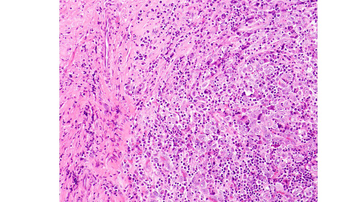 judith_ferry's tweet photo. Pathologists! What is your Dx for this cervical LN from male with cervical, supraclavicular &amp; mediastinal LAD? Any more work up needed? #lymphoma #hemepath https://t.co/xeVA1NYKg1