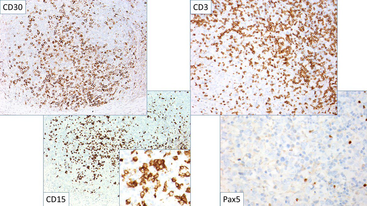judith_ferry's tweet photo. Pathologists! What is your Dx for this cervical LN from male with cervical, supraclavicular &amp; mediastinal LAD? Any more work up needed? #lymphoma #hemepath https://t.co/xeVA1NYKg1