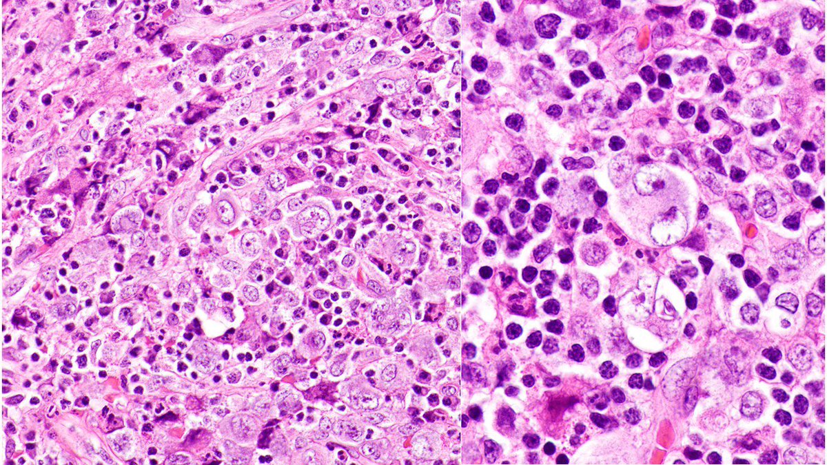 judith_ferry's tweet photo. Pathologists! What is your Dx for this cervical LN from male with cervical, supraclavicular &amp; mediastinal LAD? Any more work up needed? #lymphoma #hemepath https://t.co/xeVA1NYKg1