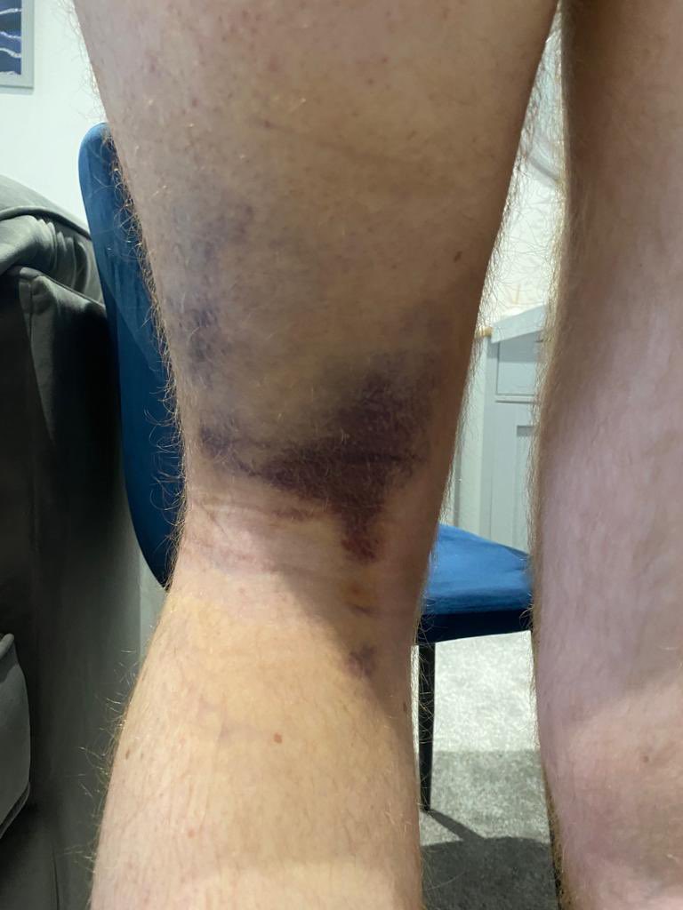 wengrow01's tweet photo. 7 days on from injury and suffering more than I thought. Doctor said it was just my calf and I’ll be fine in 5 weeks…not so sure now 😬

#injury
#footballinjury
#recovery https://t.co/UW9VsRVXqY