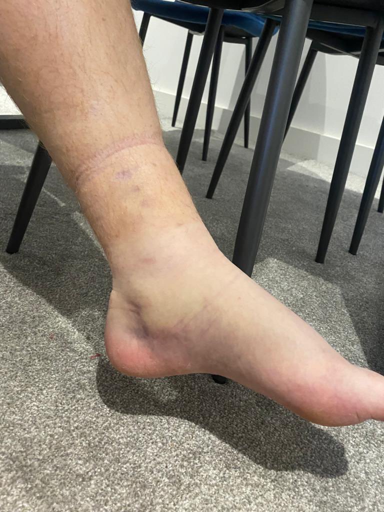 wengrow01's tweet photo. 7 days on from injury and suffering more than I thought. Doctor said it was just my calf and I’ll be fine in 5 weeks…not so sure now 😬

#injury
#footballinjury
#recovery https://t.co/UW9VsRVXqY
