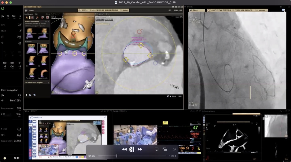 MonteHeart's tweet photo. Final wrap-up of #MonteHeartLectures this week:

@modine_thomas on his practice of #StructuralHeart combo-procedures

🎯#TAVR+M-TEER; EVOQUE #TTVR+MitraClip; Tendyne #TMVR+TAVR
➡️procedures doable, time 4 large scale data

📺Find recording via: https://t.co/MBVQoqGZou
@azeemlatib https://t.co/6zoTBAQ8V3