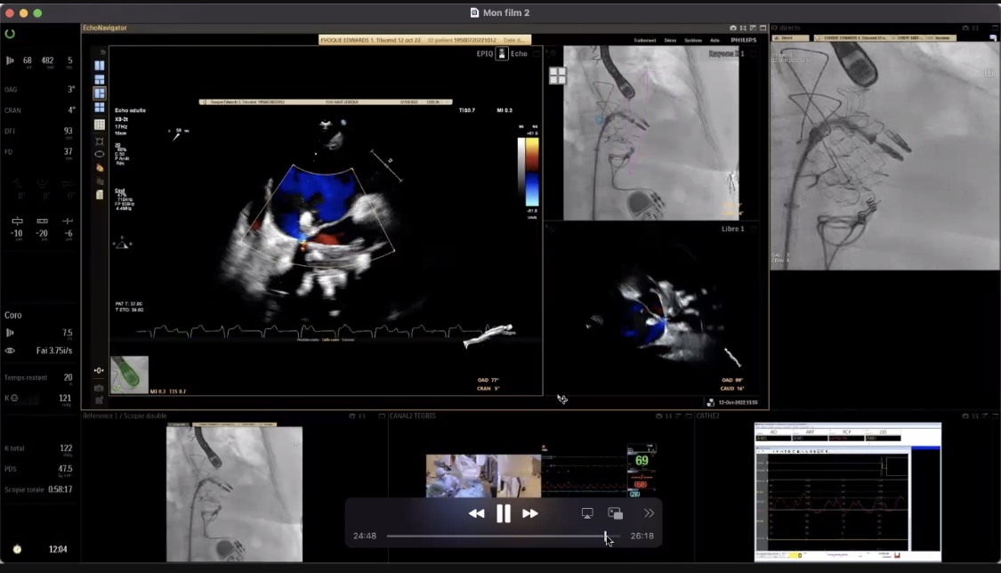 MonteHeart's tweet photo. Final wrap-up of #MonteHeartLectures this week:

@modine_thomas on his practice of #StructuralHeart combo-procedures

🎯#TAVR+M-TEER; EVOQUE #TTVR+MitraClip; Tendyne #TMVR+TAVR
➡️procedures doable, time 4 large scale data

📺Find recording via: https://t.co/MBVQoqGZou
@azeemlatib https://t.co/6zoTBAQ8V3
