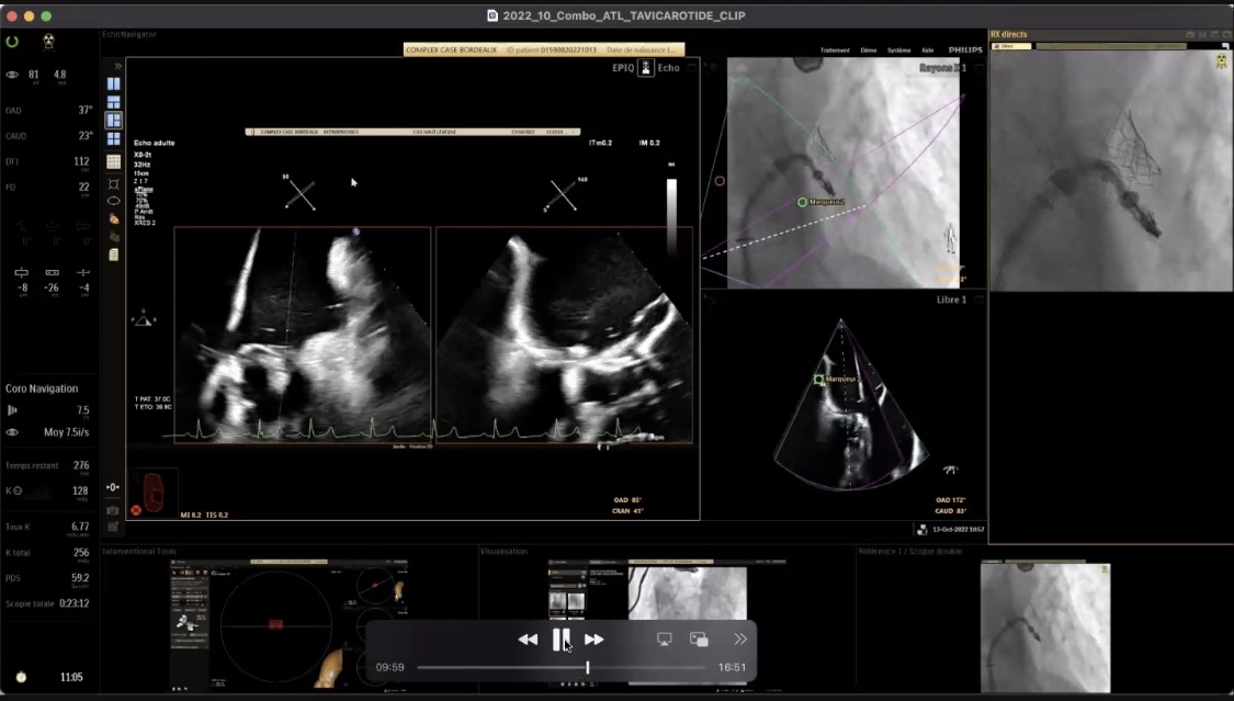 MonteHeart's tweet photo. Final wrap-up of #MonteHeartLectures this week:

@modine_thomas on his practice of #StructuralHeart combo-procedures

🎯#TAVR+M-TEER; EVOQUE #TTVR+MitraClip; Tendyne #TMVR+TAVR
➡️procedures doable, time 4 large scale data

📺Find recording via: https://t.co/MBVQoqGZou
@azeemlatib https://t.co/6zoTBAQ8V3