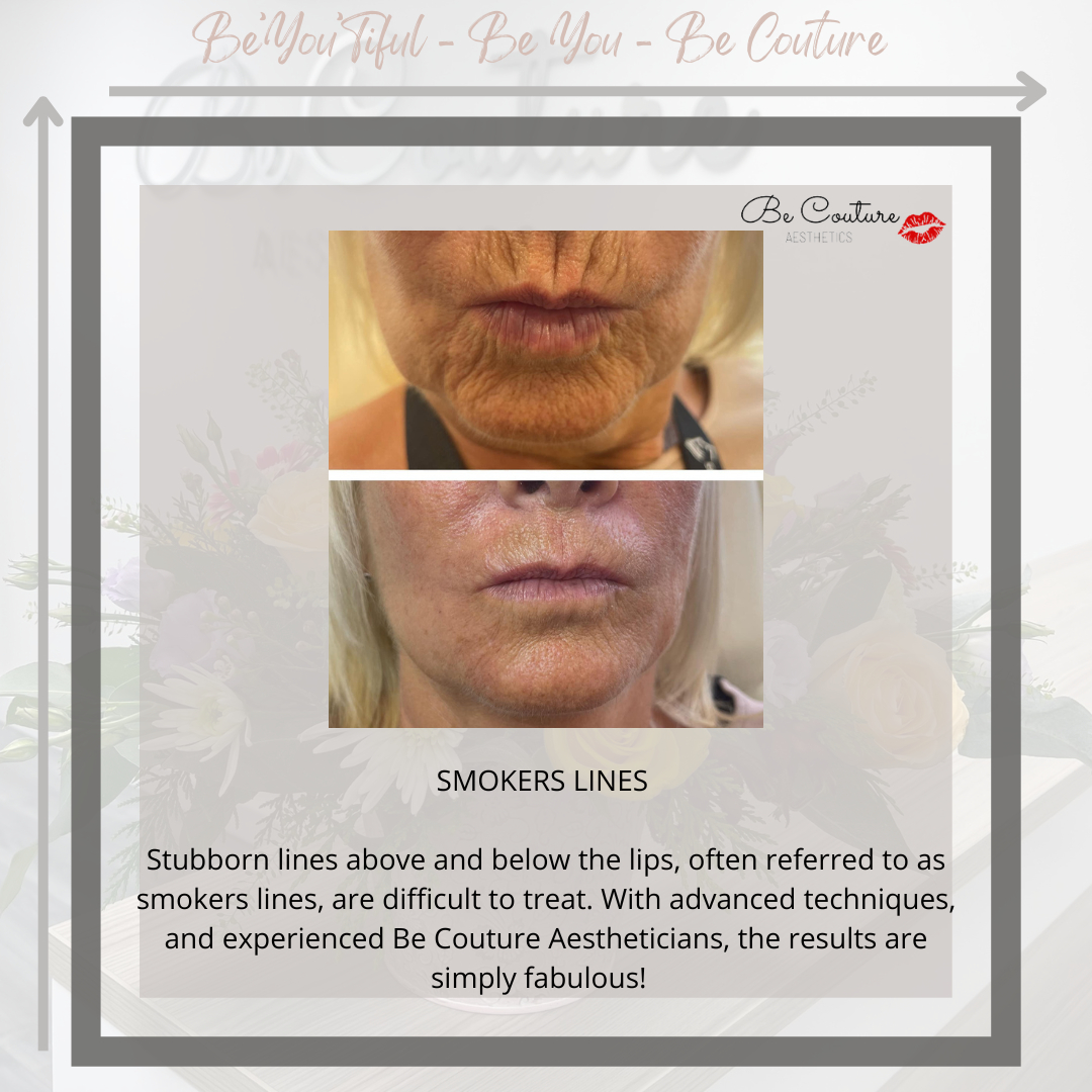 BeCoutureTrain's tweet photo. Lines around the mouth are often referred to as smokers' lines, but more often than not, they belong to a client that has never smoked. They can be difficult to treat, but here at Be Couture Aesthetics, we love a challenge, and we love filling a lip line! 

#aesthetics #antiaging https://t.co/XRfc6TE5Cv