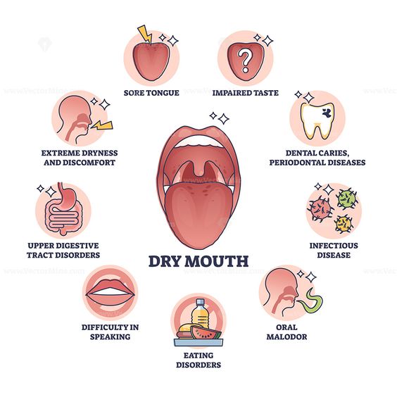 ErikJohnsonDMD's tweet photo. #Drymouth is bad news. As if the unpleasant symptoms aren't bad enough, it also makes you more susceptible to #toothdecay. [#Infographic] https://t.co/OX6Zz8UqzW