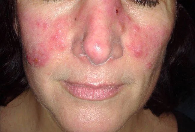 Pharma_Connect's tweet photo. ادوية تسبب مرض الذئبة كعرض جانبي 🔴
Drugs induce lupus syndrome https://t.co/vpJH8s5gfn