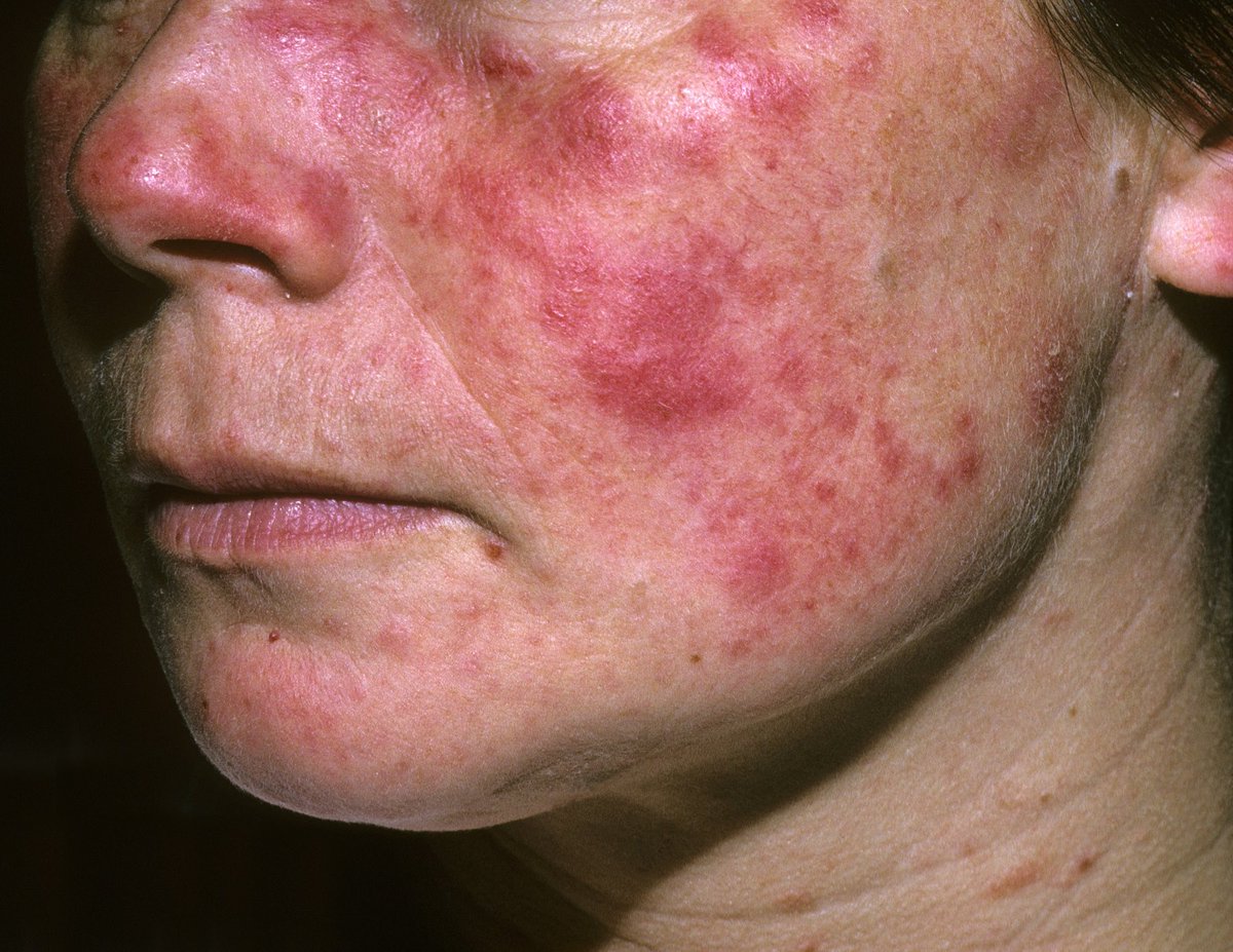 Pharma_Connect's tweet photo. ادوية تسبب مرض الذئبة كعرض جانبي 🔴
Drugs induce lupus syndrome https://t.co/vpJH8s5gfn