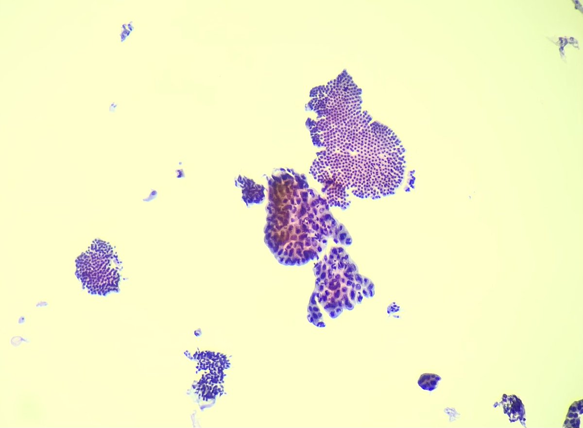 Gorgeous day here in #Chicago screening #cytology slides on the @Pathologists #CytoPath committee. What’s on my scope? Biliary brushing. Couldn’t get any better than this contrasting morphology. For your viewing pleasure #MorphologyRules #PathTwitter