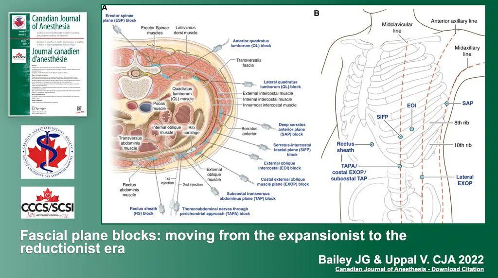 Fascial plane blocks: moving from the expansionist to the reductionist era | from @jon_bailey_anes & @Ropivacaine #regionalanesthesia #Anesthesia #Anesthesiology buff.ly/3RivCPV