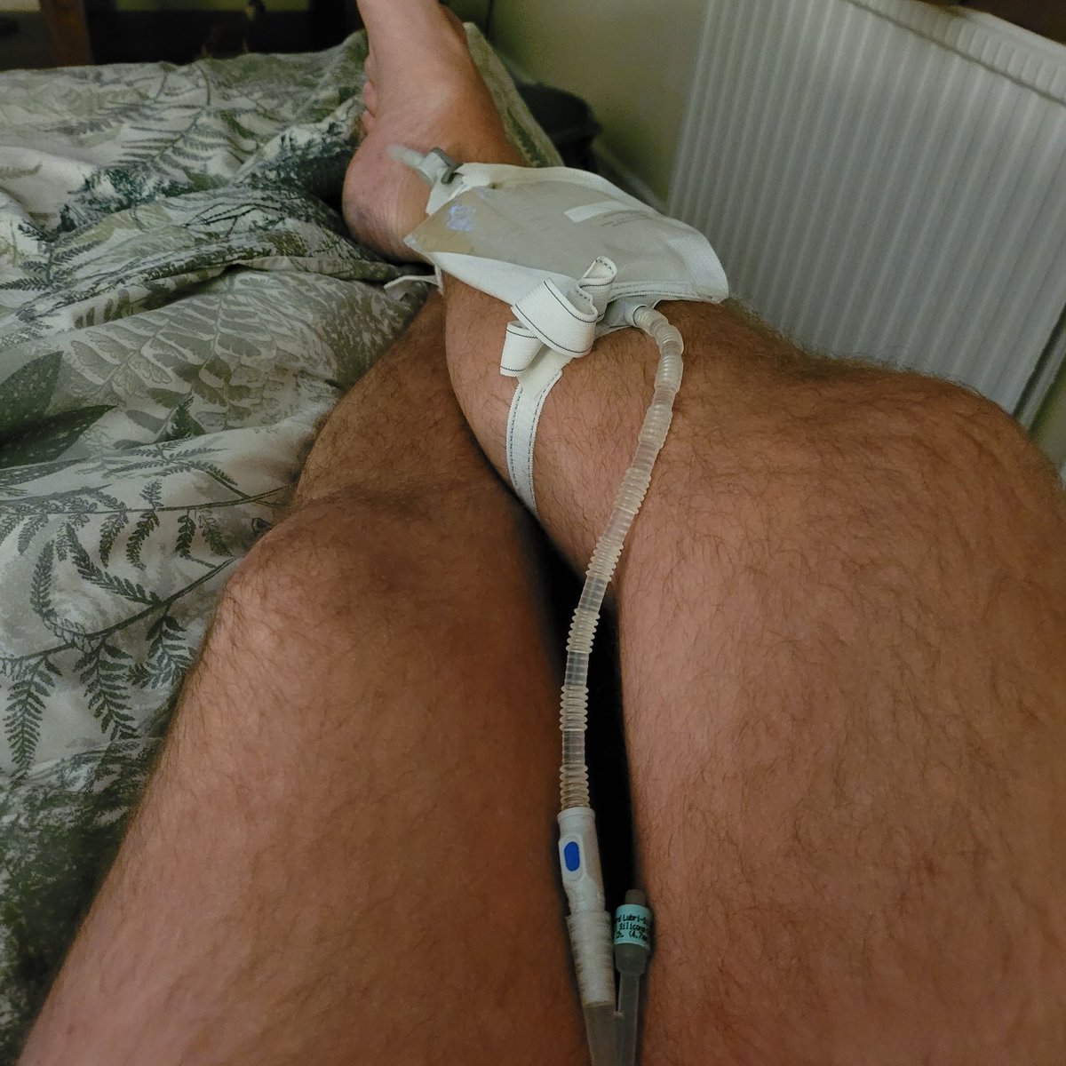 TommyBarwick2's tweet photo. The real life of a #homophobic attack survivor 4 years later after having my back broken. Still have problems and am wearing a catheter because I can't wee. #caseyreport #victim #homophobia @MOPACLdn @GalopUK let down by @metpoliceuk #survivor @BBCNews @LDNVictimsComm https://t.co/Rla0SeBOWx