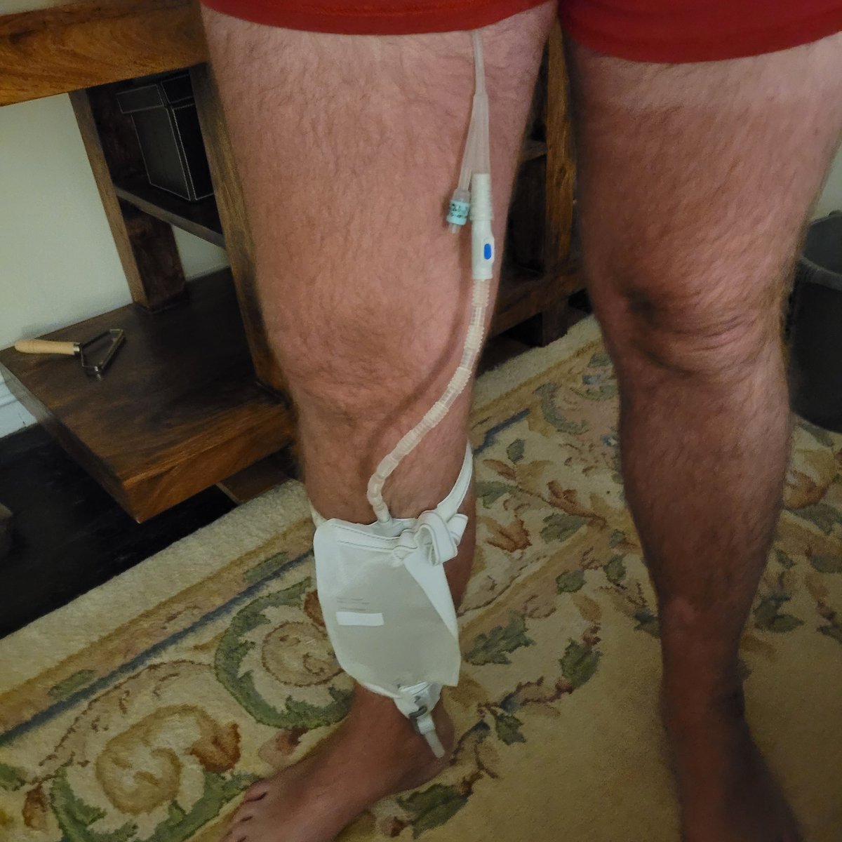 TommyBarwick2's tweet photo. The real life of a #homophobic attack survivor 4 years later after having my back broken. Still have problems and am wearing a catheter because I can't wee. #caseyreport #victim #homophobia @MOPACLdn @GalopUK let down by @metpoliceuk #survivor @BBCNews @LDNVictimsComm https://t.co/Rla0SeBOWx