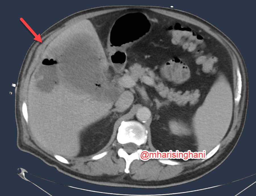 Hypotensive diaphoretic with negative Murphy's sign; gangrenous cholecystitis with intrahepatic abscess