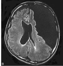 AvrahamCooperMD's tweet photo. This man had almost his entire left cerebral hemisphere knocked out by an arachnoid cyst.

HE WAS ASYMPTOMATIC AND SPOKE 3 LANGUAGES 

#medtwitter https://t.co/iNf2e0JuOq