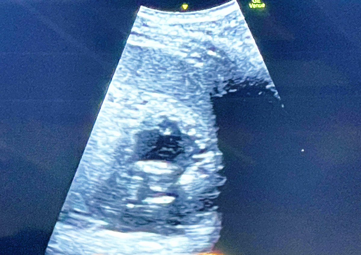 FOAMecmo's tweet photo. 🧵 Abd #POCUs
🖥️ move to sovrapubic scan
🖥️ left upper quad: right infrasplenic view (infradiaphrag) most frequent site for + finding
curtain sign = pleural effusion ruled out
sliding = PTX/selective intubation ruled out
Confirm finding w multiple views
@francescorradi #LIVES2022 https://t.co/9iQVGKdceC