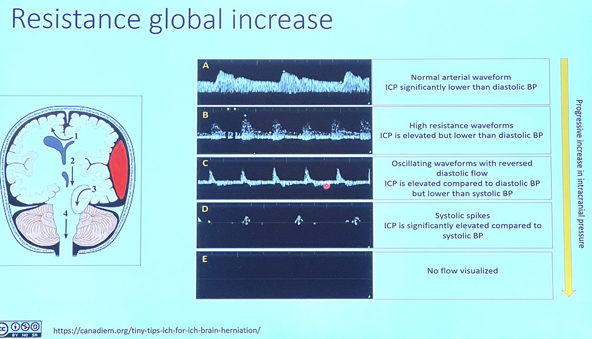 FOAMecmo's tweet photo. 🦋 Brain #ultrasound? NOT only in neurocritically ill but also in general #ICU ie after cardiac arrest or #sepsis
4 windows
🪟 temporal (major)
🪟 submandibular (carotid)
🪟 optical (linear probe for OSND)
🪟 suboccipital (vertebral/basilar)
#LIVES2022
@chiara_robba @aartisarwal https://t.co/XUz4u0ZOCC